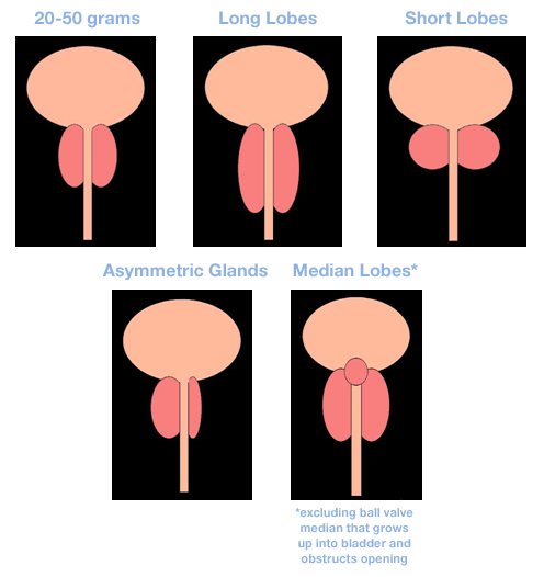 asymmetrical prostate symptoms
