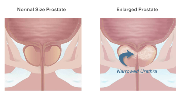 Prostate Hyperplasia 2 Art Hozz